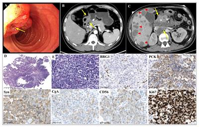 Case Report: Gastrointestinal neuroendocrine carcinoma with SMARCA4 deficiency: a clinicopathological report of two rare cases